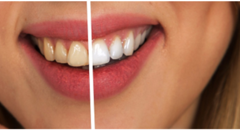 zoom or enlighten teeth whitening